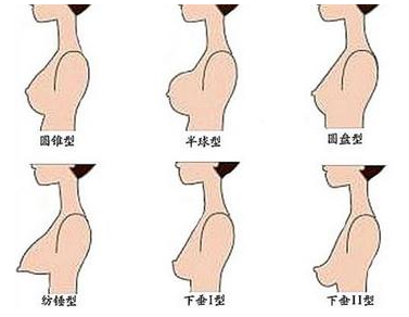 圆锥型胸穿什么内衣